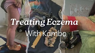 Treating Eczema With a Sacred Kambo Ceremony [upl. by Rory309]