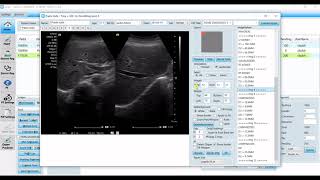 pCare Radiology Tool  Auto Reporting  Offline Annotation Measurement [upl. by Auqkinahs88]