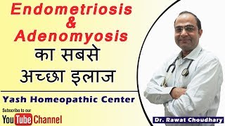 Endometriosis का सबसे अच्छा सफल इलाज  Adenomyosis बेस्ट इलाज [upl. by Ehgit]