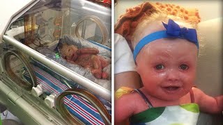 New York Babys Skin Cracked Minutes After Her Birth Due to Rare Condition [upl. by Lajet]