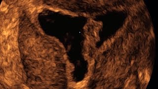 Intrauterine Adhesions on Sonohysterography [upl. by Jerroll]