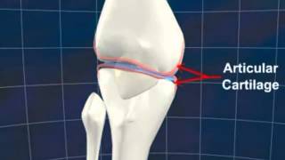 What is Osteoarthritis by St Pete Hip and Knee [upl. by Brigg630]