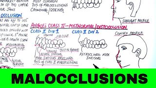 Angles Classification of Malocclusion  Orthodontics [upl. by Korella545]