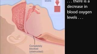 How CPAP works 52311wmv [upl. by Fabrice141]