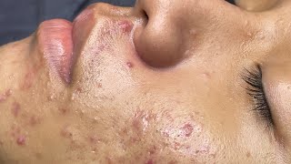 ACNE TREATMENT VU QUYNH MI Acne On Boys Cheek 2024 [upl. by Lauter449]