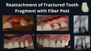 Tooth Fragment Reattachment  How to fix a broken tooth  Crown Fracture  Dental Trauma [upl. by Asquith]