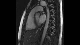 heart beat  MRI video of my beating heart sagittal view [upl. by Laurance598]