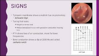 Otosclerosis part 2 by Dr Fatima Ammir [upl. by Lajib]