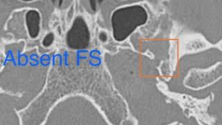 PERSISTENT STAPEDIAL ARTERY [upl. by Meador]