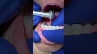 Interproximal Reduction of the Anterior Teeth Part 2 Overlapping Incisors [upl. by Mines]