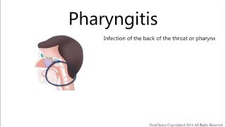 Viral pharyngitis [upl. by Ztnahc]