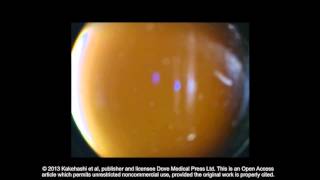 Classification of posterior vitreous detachment ID 54021 Supplementary video 4 [upl. by Eitisahc]