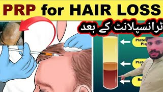 PRP Hair treatment again naya pakistan Khuram Abbas [upl. by Shapiro]