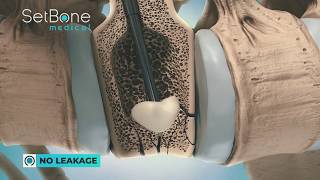 SetBone Medicals novel bone cement [upl. by Kcirderf]