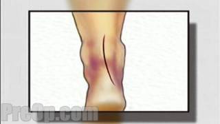 Achilles Tendon Repair Surgery PreOp® Patient Education HD [upl. by Yarised]