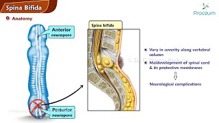 Spina Bifida  Orthopedics Lecture [upl. by Leverett]