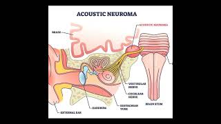 Acoustic Neuroma Symptoms and Causes  Diagnosis  Treatment  Prevention disease health [upl. by Enrak]