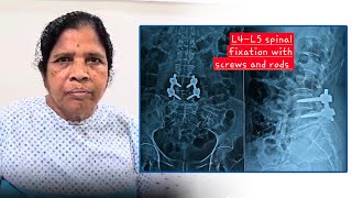 Spinal Fixation Surgery for L4 vertebrae over L5 with LCS  Patient Testimonial  Dr Ravi Kumar [upl. by Ojyma14]