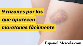 9 razones por las que aparecen moretones fácilmente [upl. by Rebekkah]