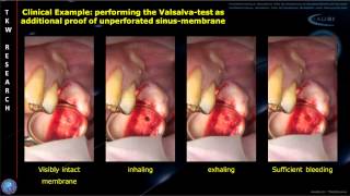 INTRALIFT Histology Study JOMS Audioslides [upl. by Leia]