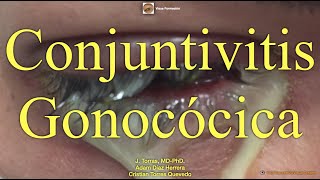 Conjuntivitis Gonocócica [upl. by Kalina]