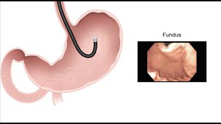 HCC 14753b  Stomach  Endoscopy findings of normal anatomy [upl. by Reltuc960]