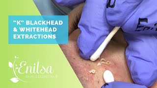 Blackheads Whiteheads Extractions on quotKquot  Part 2 [upl. by Eisor]