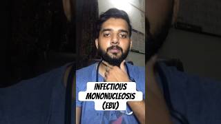 Infectious Mononucleosis due to Ebstein Bar Virus medical mbbs ebv [upl. by Lothar]