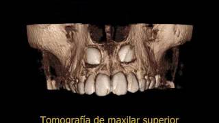 Tomografía Dientes Incluídos en maxilar superior  RXORAL 3D [upl. by Lila239]