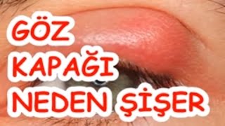 GÖZ KAPAĞI NEDEN ŞİŞER [upl. by Mikiso]