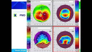 Quick guide to reading corneal tomography Part 6 [upl. by Tiertza244]