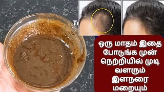 முன் நெற்றியில் முடி அடர்த்தியாக வளரும் இளநரை மறையும்  front bald hair growth  grey hair oil [upl. by Leeann]