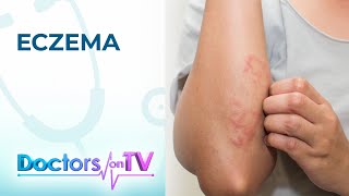 Eczema Symptoms Causes and Treatment  Doctors on TV [upl. by Matthaus436]