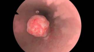 Polypectomy  Polyp Removal  New Features for Virtual Reality Surgical Simulation [upl. by Nnoj489]