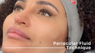 Periocular Fluid Technique complete protocol by Dr Siquier amp Dr Taskesen [upl. by Otxis]