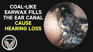 COALLIKE CERUMEN FILLS The Ear Canal Causes Hearing Loss [upl. by Mazur]