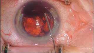 Safe and Simple Hyphema Removal [upl. by Anerahs]