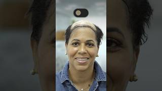 1 YEAR HAIR TRANSPLANT RESULTS  AFRO FEMALE WITH CCCA TYPE HAIR LOSS afrohairtransplant [upl. by Weihs]