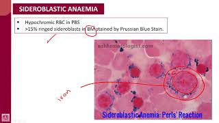 Hematology  1  U8L4  Sideroblastic anaemia [upl. by Clarke769]