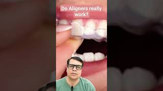 Do Aligners Really work youtubeshorts shortvideo shorts short teeth braces aligners [upl. by Hotchkiss]