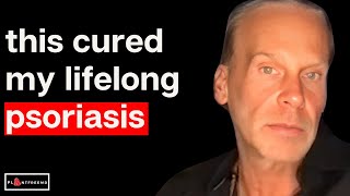 🔴 Finding Out The Truth About Psoriasis After 30 Years of Suffering  Stephen Lashbrook [upl. by Autrey]