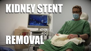 Post Kidney Transplant Stent Removal  Mens Cystoscopy procedure [upl. by Bucky325]