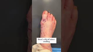 Elder Patients Fixed Bunion amp Hammertoe 😮 [upl. by Seafowl585]