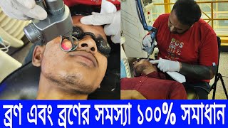 মুখে ব্রণ ব্রণের গর্তের সমাধান ১০০  acne and acne scars problem solve price in BD [upl. by Yezdnil]