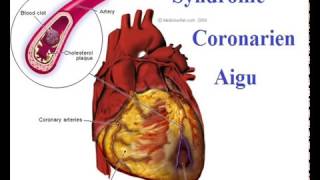 Syndrome coronarien Conduite à Tenir devant une crise cardiaque [upl. by Barclay368]