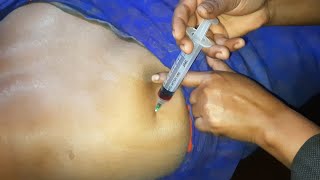 Buttock injection video Vitamin b1b6b12 quotBecobionquot Intramuscular buttock injection push 24 Ep 54 [upl. by Jacqueline282]