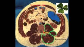 Ultrasound guided Quadratus Lumborum Block QLB1 [upl. by Ireland215]