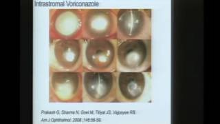 Innovations in Fungal Keratitis [upl. by Emersen]