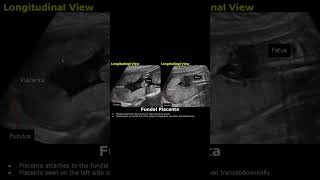 Posterior amp Fundal Placental Position On Ultrasound  Pregnancy USG posteriorplacenta placenta [upl. by Yarled]