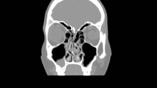 Coronal CT Scan of a right antrochoanal polyp [upl. by Manuela]